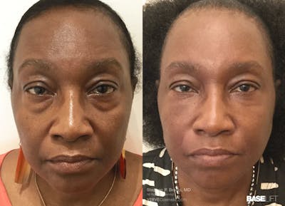 Baselift™ Before & After Gallery - Patient 118052 - Image 1