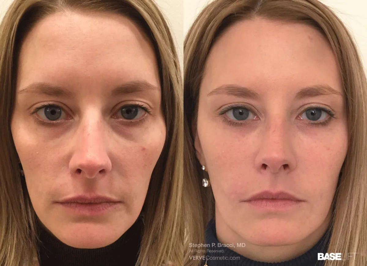 Baselift™ Before & After Gallery - Patient 313216 - Image 1