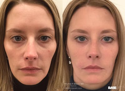 Baselift™ Before & After Gallery - Patient 313216 - Image 1