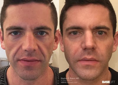 Baselift™ Before & After Gallery - Patient 389384 - Image 1