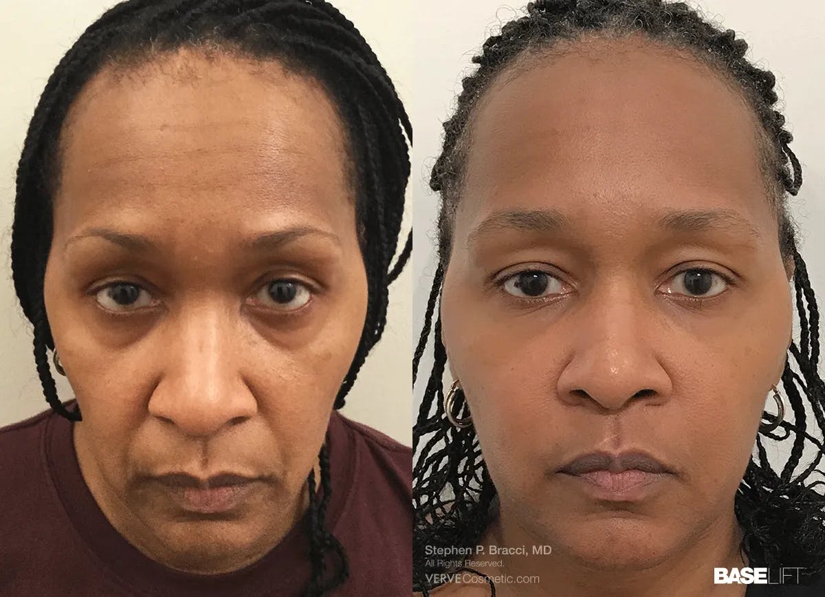 Baselift™ Before & After Gallery - Patient 168986 - Image 1
