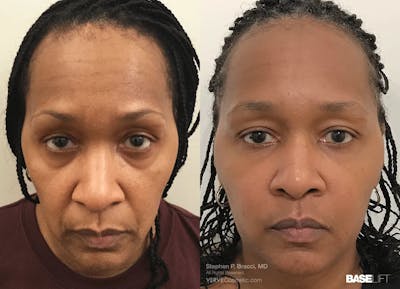 Baselift™ Before & After Gallery - Patient 168986 - Image 1