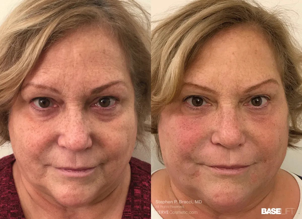 Baselift™ Before & After Gallery - Patient 401381 - Image 1