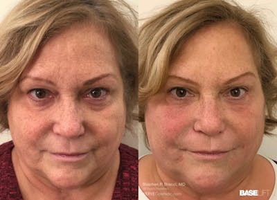 Baselift™ Before & After Gallery - Patient 401381 - Image 1