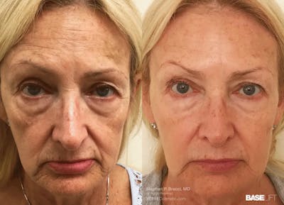 Baselift™ Before & After Gallery - Patient 360581 - Image 1