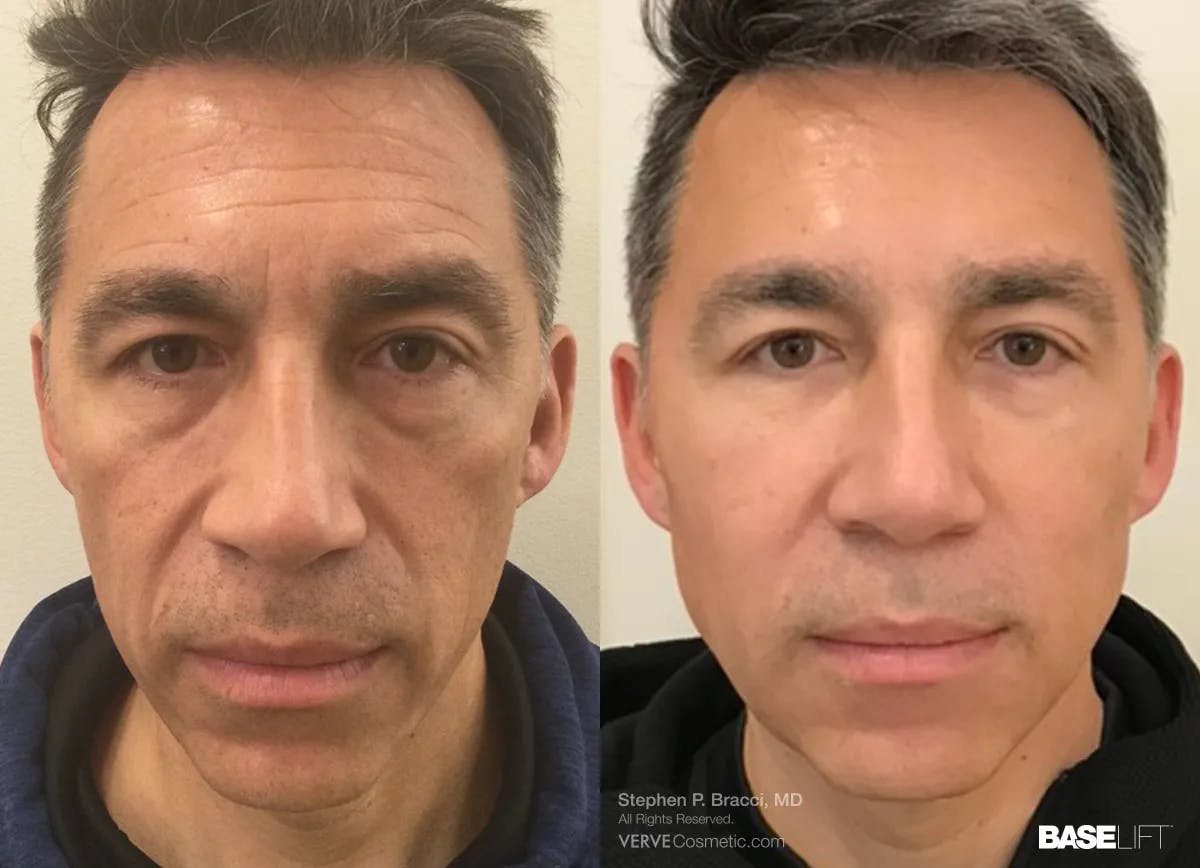 Baselift™ Before & After Gallery - Patient 107824 - Image 1