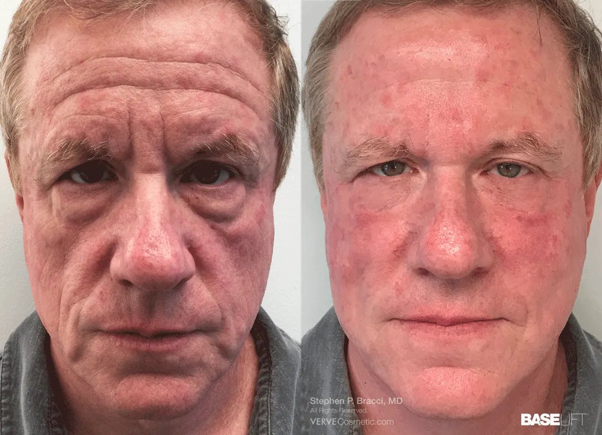 Baselift™ Before & After Gallery - Patient 118527 - Image 1