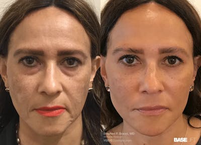 Baselift™ Before & After Gallery - Patient 291313 - Image 1
