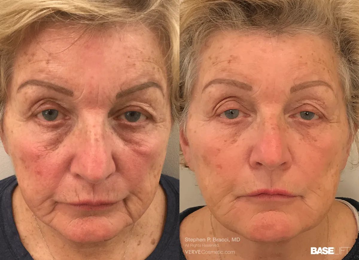 Baselift™ Before & After Gallery - Patient 412092 - Image 1