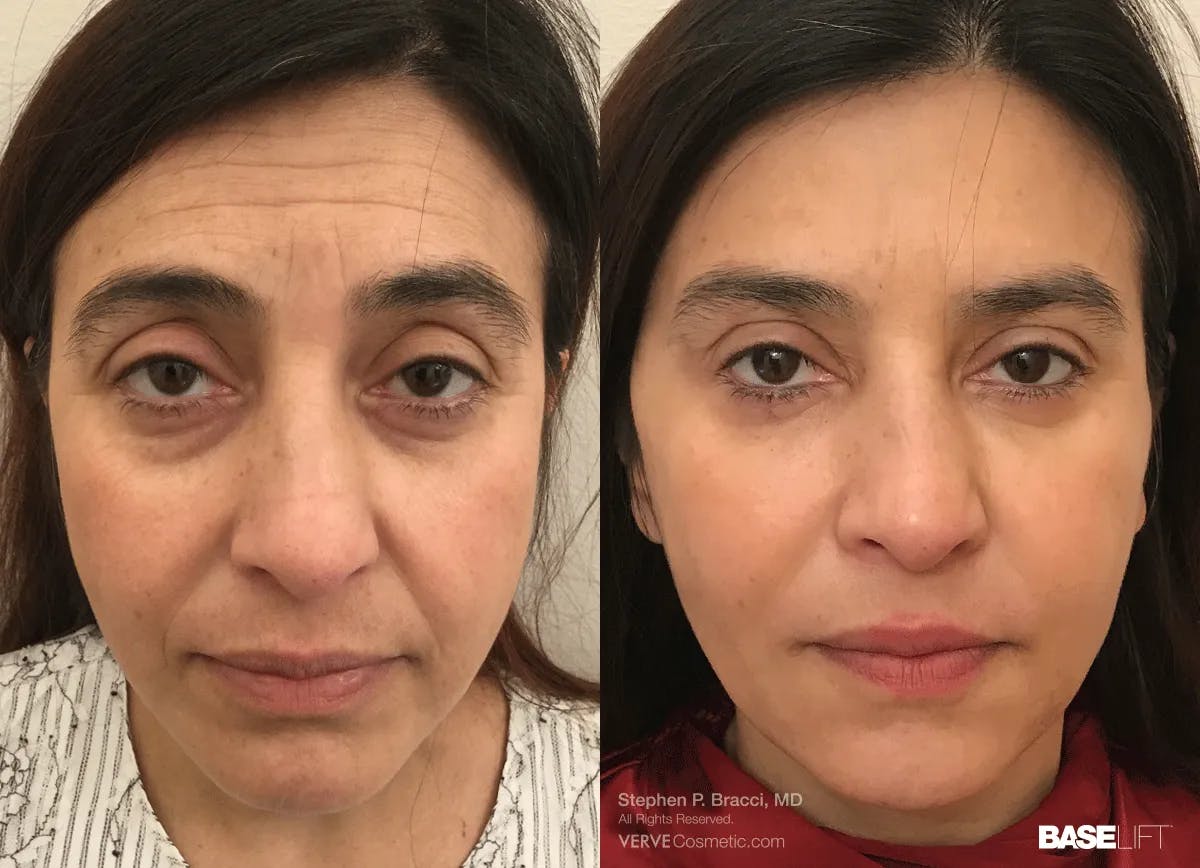 Baselift™ Before & After Gallery - Patient 320211 - Image 1