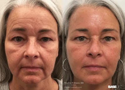 Baselift™ Before & After Gallery - Patient 315213 - Image 1