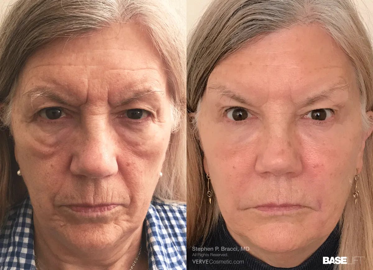 Baselift™ Before & After Gallery - Patient 282425 - Image 1