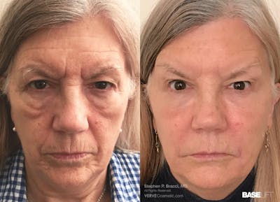 Baselift™ Before & After Gallery - Patient 282425 - Image 1