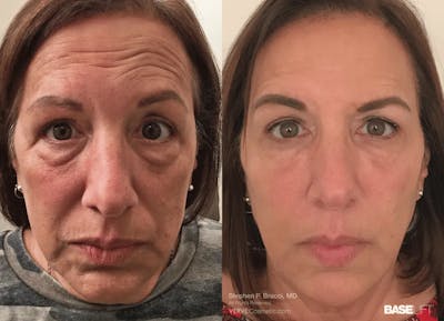 Baselift™ Before & After Gallery - Patient 604868 - Image 1