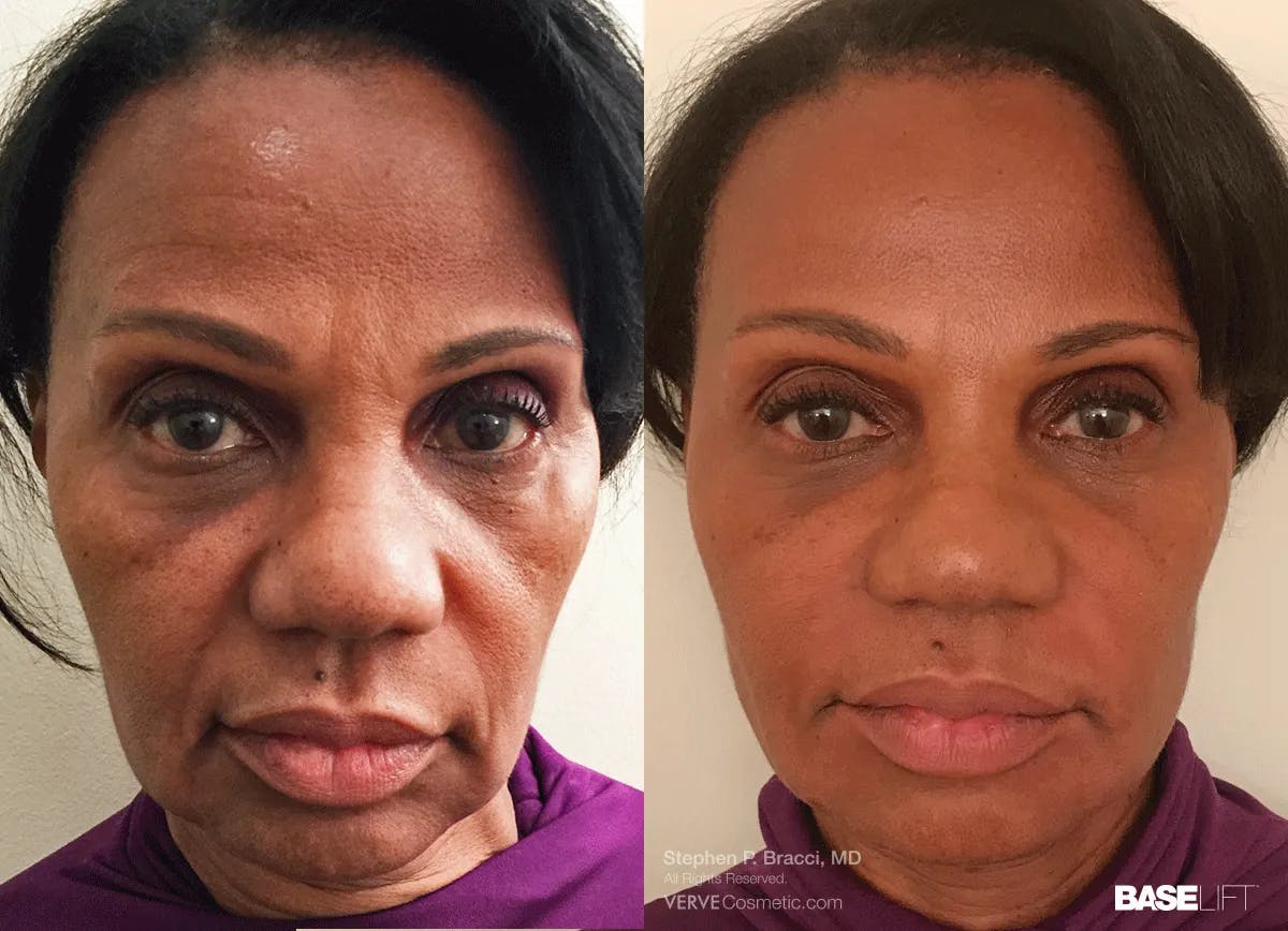 Baselift™ Before & After Gallery - Patient 233411 - Image 1