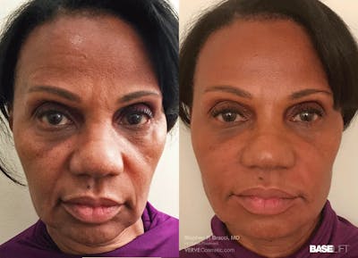 Baselift™ Before & After Gallery - Patient 233411 - Image 1