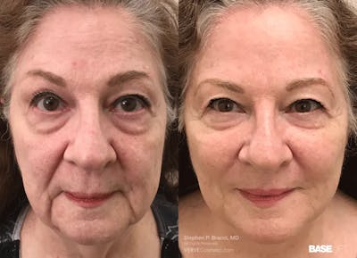 Baselift™ Before & After Gallery - Patient 106352 - Image 1
