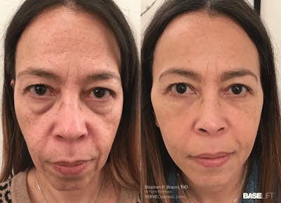 Baselift™ Before & After Gallery - Patient 371967 - Image 1
