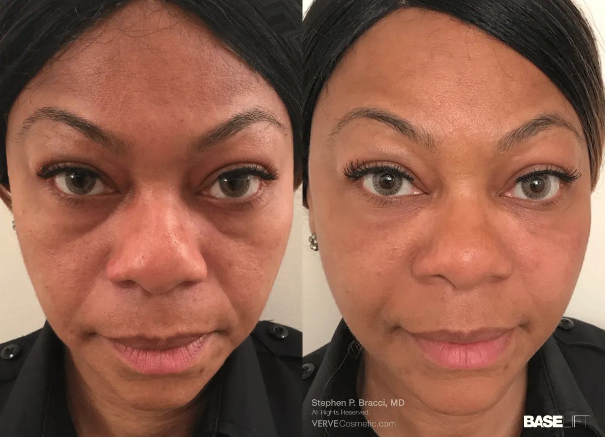 Baselift™ Before & After Gallery - Patient 137423 - Image 1