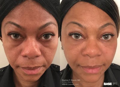 Baselift™ Before & After Gallery - Patient 137423 - Image 1