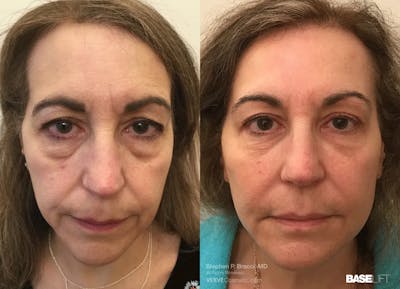 Baselift™ Before & After Gallery - Patient 426224 - Image 1