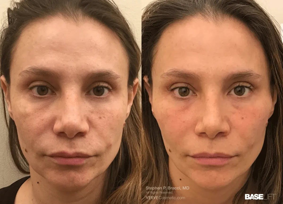 Baselift™ Before & After Gallery - Patient 123176 - Image 1