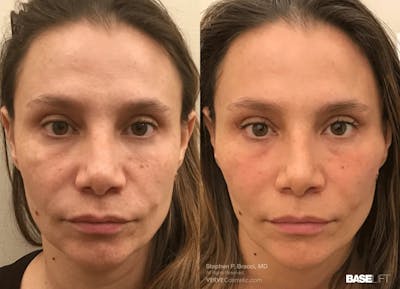 Baselift™ Before & After Gallery - Patient 123176 - Image 1