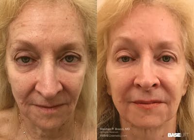 Baselift™ Before & After Gallery - Patient 189795 - Image 1
