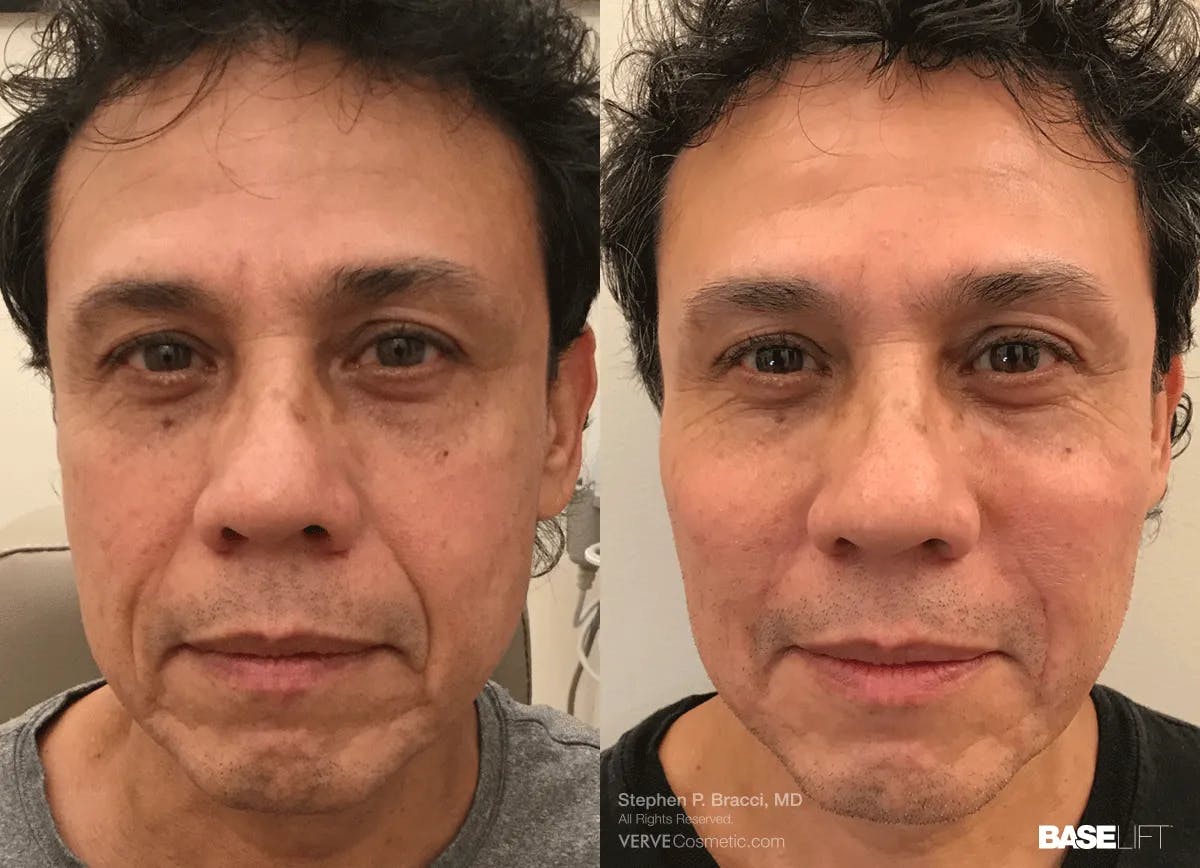 Baselift™ Before & After Gallery - Patient 429442 - Image 1