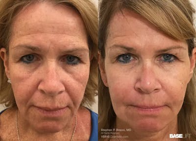 Baselift™ Before & After Gallery - Patient 291650 - Image 1