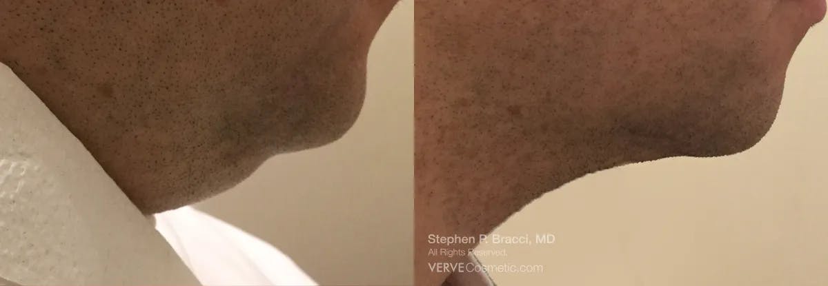 Chin Fat Before & After Gallery - Patient 322758 - Image 1