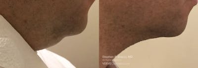 Chin Fat Before & After Gallery - Patient 322758 - Image 1
