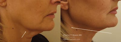 Chin Fat Before & After Gallery - Patient 410714 - Image 1