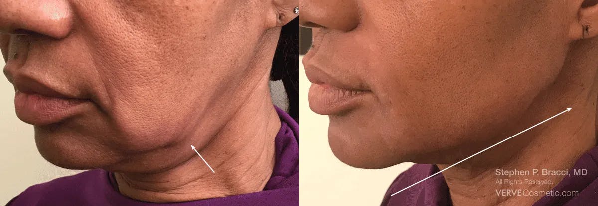 Jawline Area (Chin) Contouring Before & After Gallery - Patient 173971 - Image 1