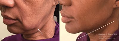 Chin Fat Before & After Gallery - Patient 114466 - Image 1