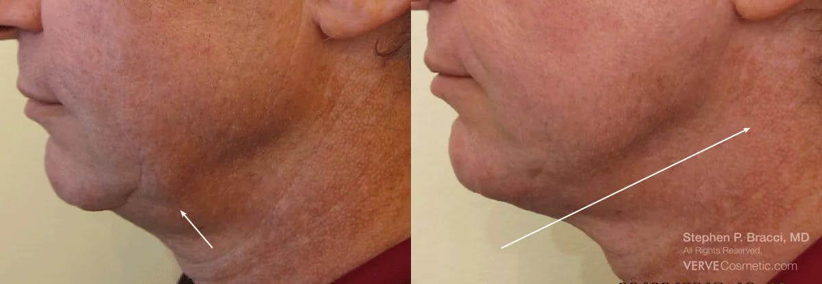 Jawline Area (Chin) Contouring Before & After Gallery - Patient 111559 - Image 1