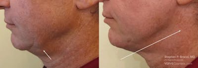 Chin Fat Before & After Gallery - Patient 198348 - Image 1