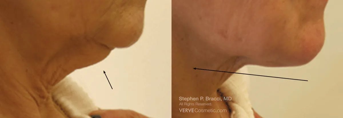 Chin Fat Before & After Gallery - Patient 351501 - Image 1