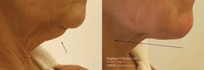 Chin Fat Before & After Gallery - Patient 351501 - Image 1