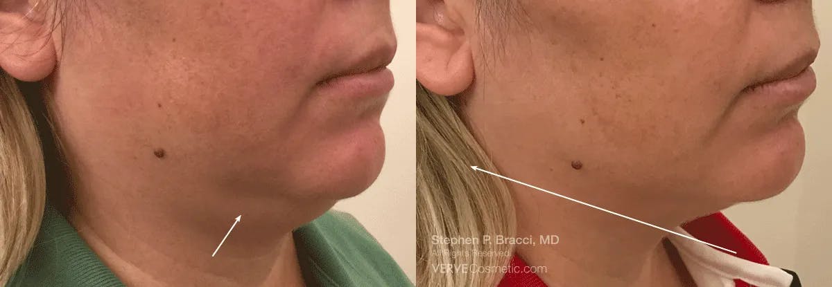 Chin Fat Before & After Gallery - Patient 496257 - Image 1