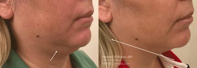 Chin Fat Before & After Gallery - Patient 496257 - Image 1
