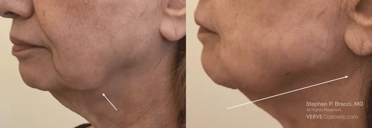 Chin Fat Before & After Gallery - Patient 310370 - Image 1