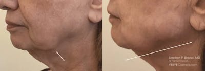 Chin Fat Before & After Gallery - Patient 310370 - Image 1