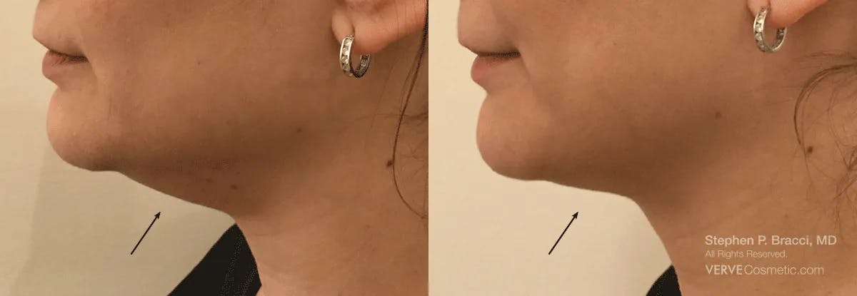 Chin Fat Before & After Gallery - Patient 359350 - Image 1