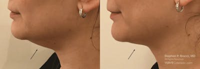 Chin Fat Before & After Gallery - Patient 359350 - Image 1