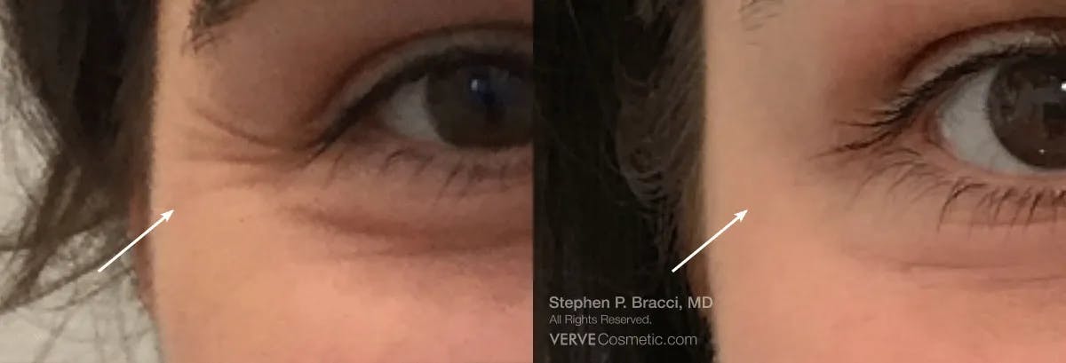 Crow's Feet (Botox) Before & After Gallery - Patient 345322 - Image 1