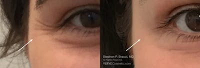 Crow's Feet (Botox) Before & After Gallery - Patient 345322 - Image 1