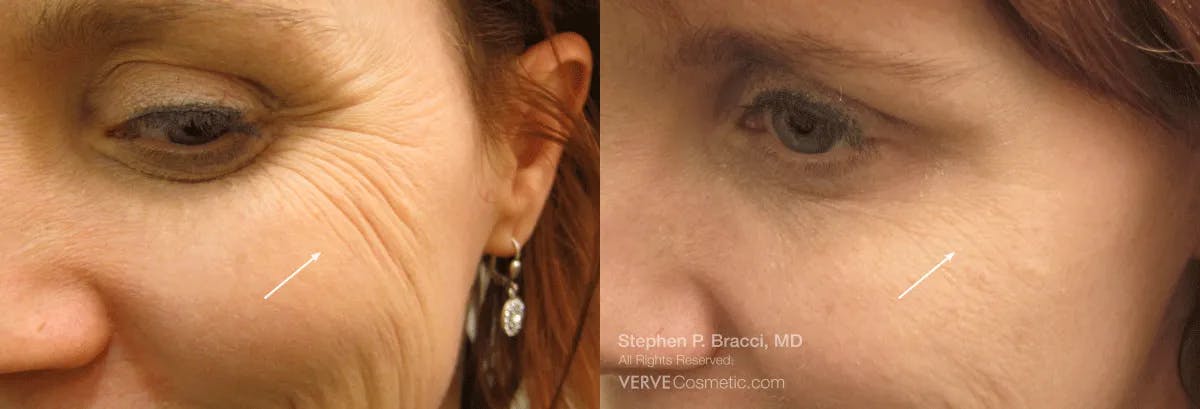 Crow's Feet (Botox) Before & After Gallery - Patient 393108 - Image 1