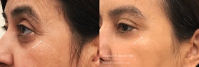 Crow's Feet (Botox) Before & After Gallery - Patient 311475 - Image 1