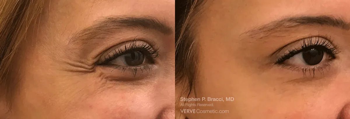 Crow's Feet (Botox) Before & After Gallery - Patient 595234 - Image 1